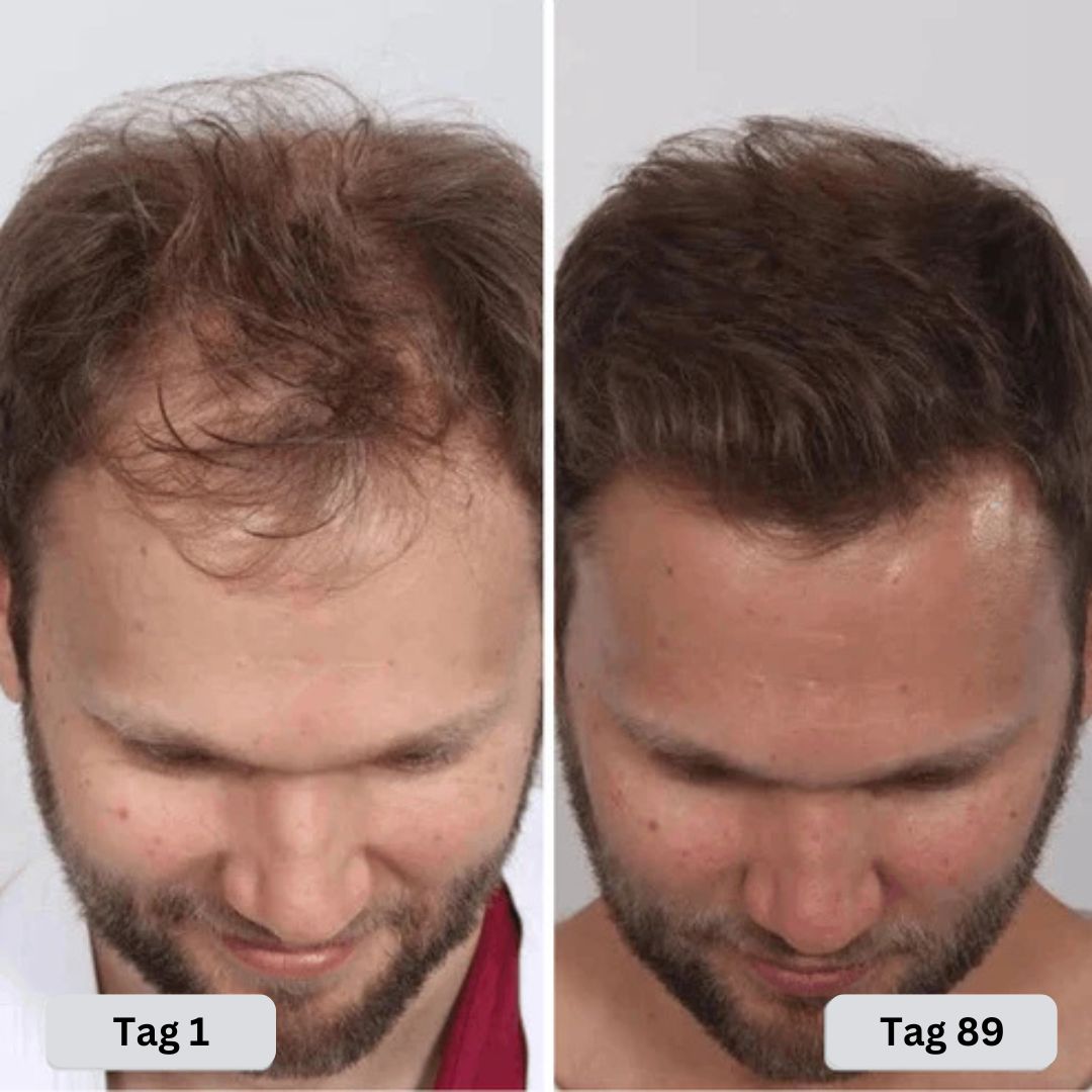 Rotlicht Therapie Cap Nachwachsendes Haar