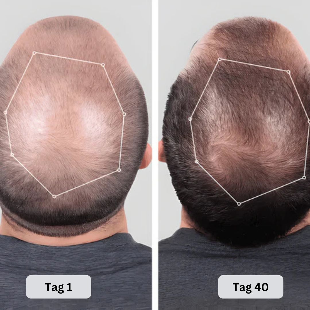 Rotlicht Therapie Cap Nachwachsendes Haar