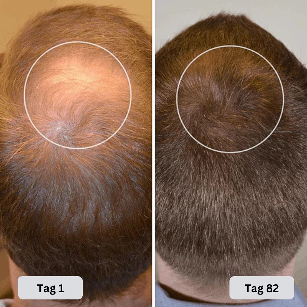 Rotlicht Therapie Cap Nachwachsendes Haar