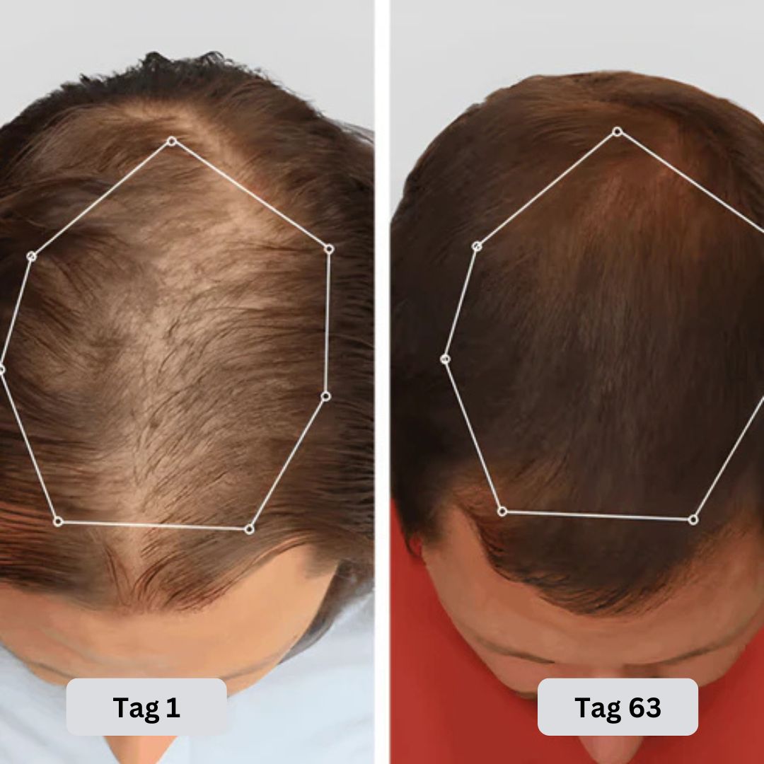 Rotlicht Therapie Cap Nachwachsendes Haar